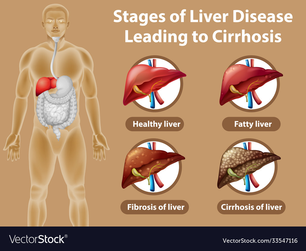 Stages liver disease leading to cirrhosis Vector Image