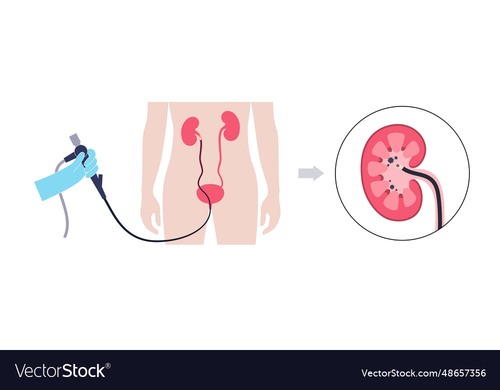 Ureteroscopy medical poster