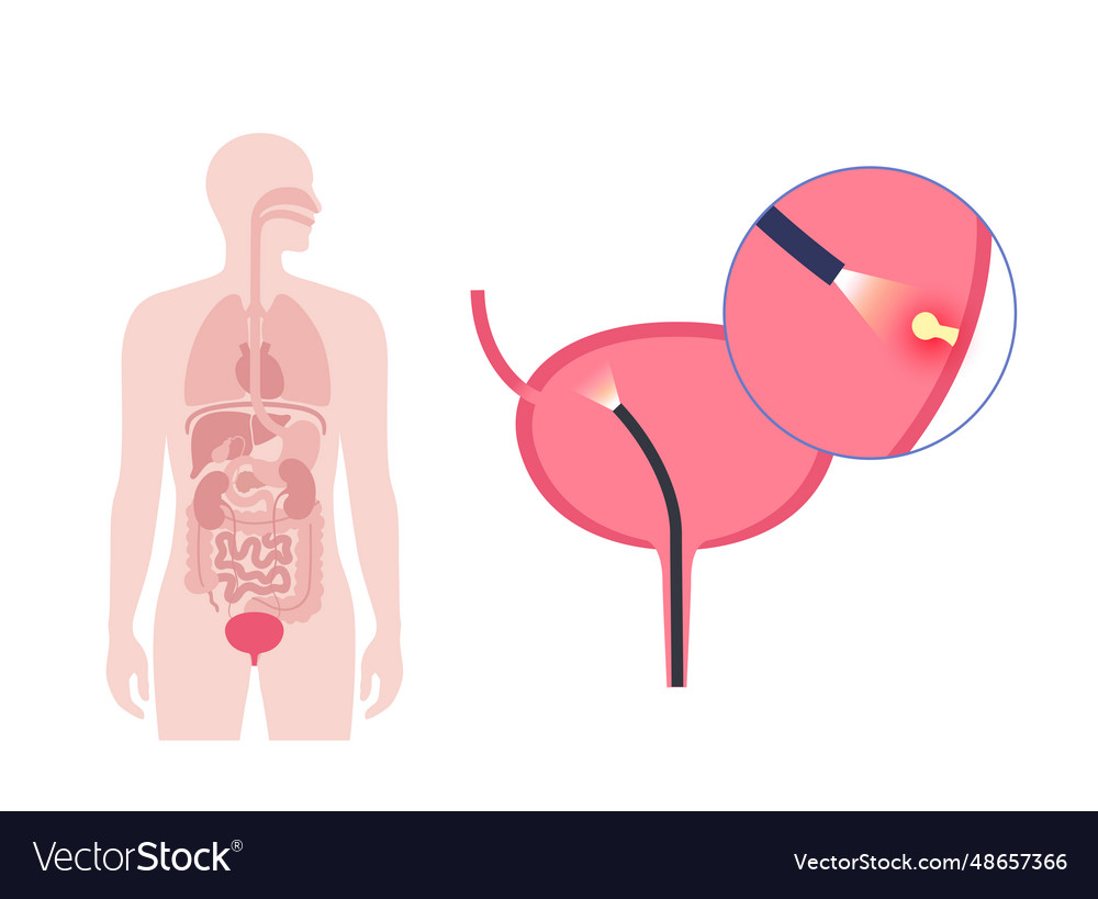 Cystoscopy examination concept