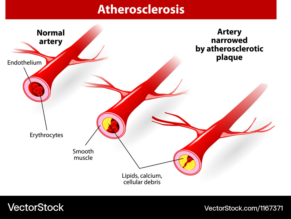 Atherosclerosis Royalty Free Vector Image Vectorstock