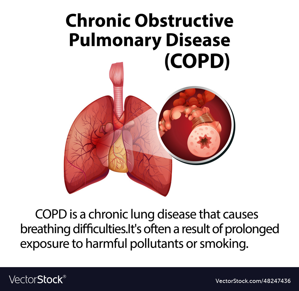 Science education of human anatomy copd Royalty Free Vector