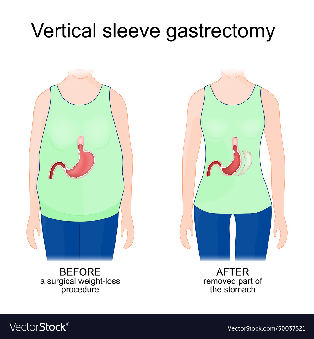 Vertical sleeve gastrectomy human body before