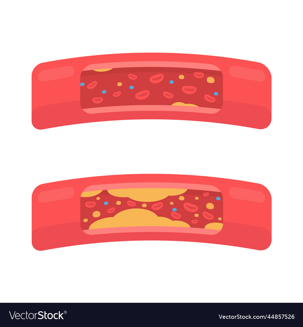 Coronary arteries with accumulated fat in the body