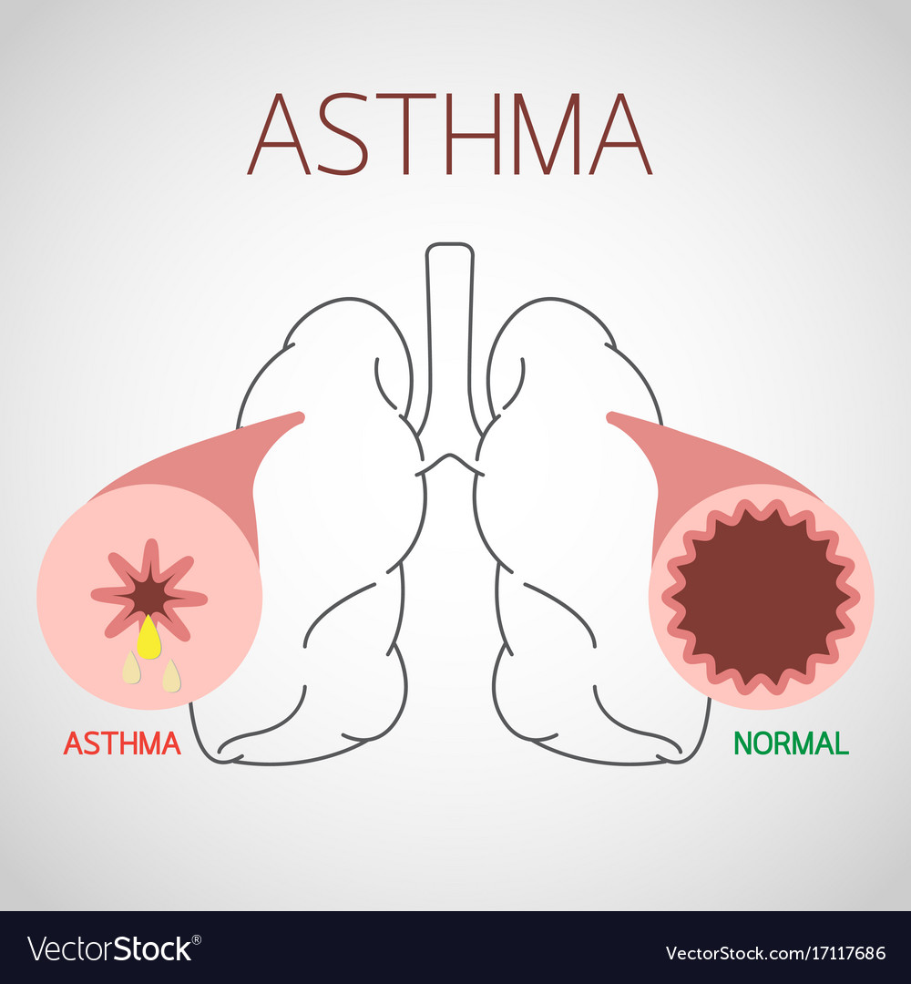 Asthma icon Royalty Free Vector Image - VectorStock