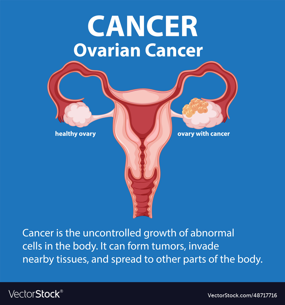 Comparing normal and cancerous ovaries in medical Vector Image