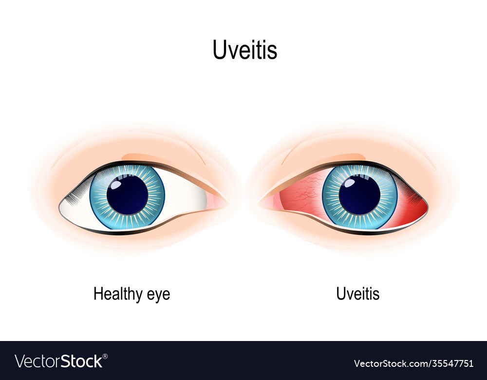 Uveitis inflammation eye Royalty Free Vector Image