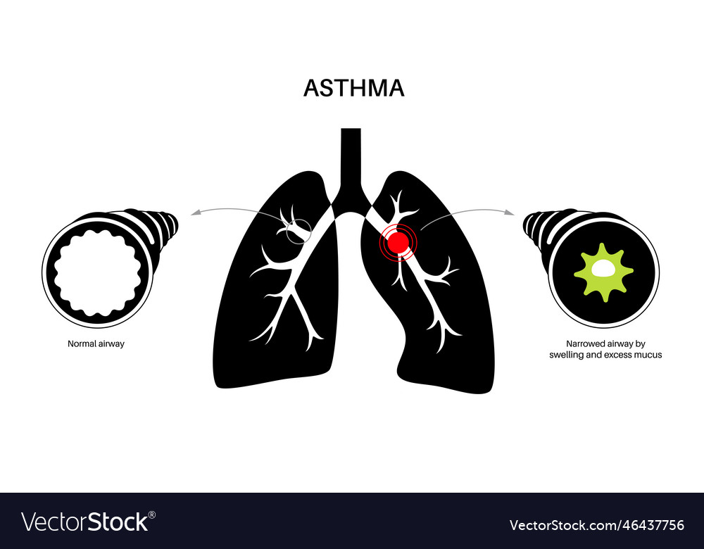 Asthma lung disease Royalty Free Vector Image - VectorStock