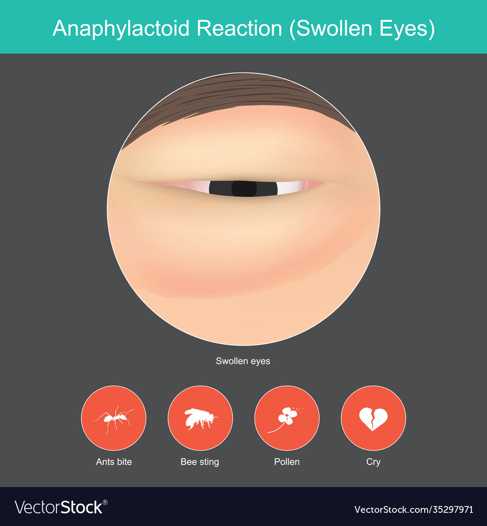 Anaphylactoid reaction show close up around