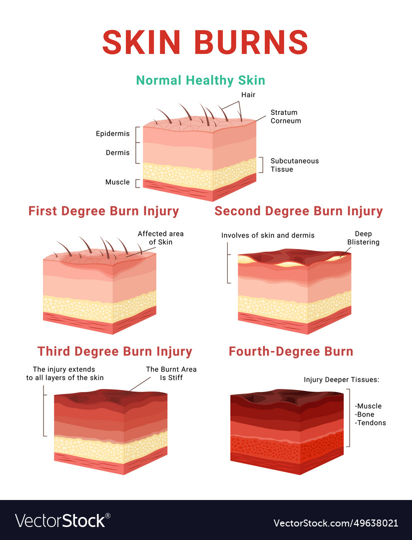 Skin burn classification infographic medical Vector Image