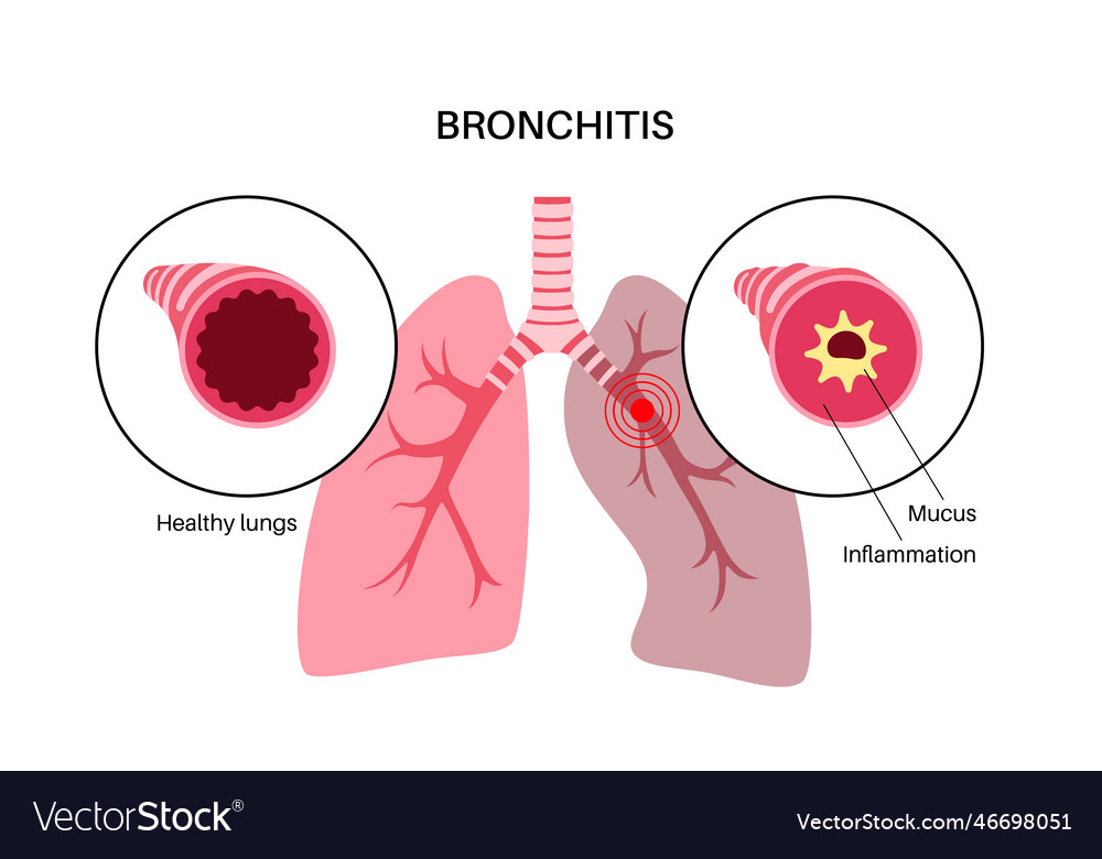 Bronchitis lung disease Royalty Free Vector Image