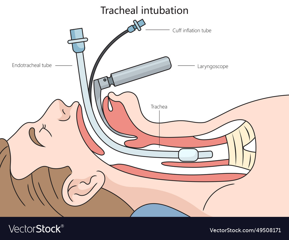 Tracheal intubation diagram medical science Vector Image