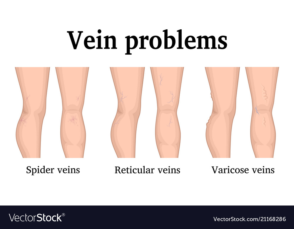 Vein problems