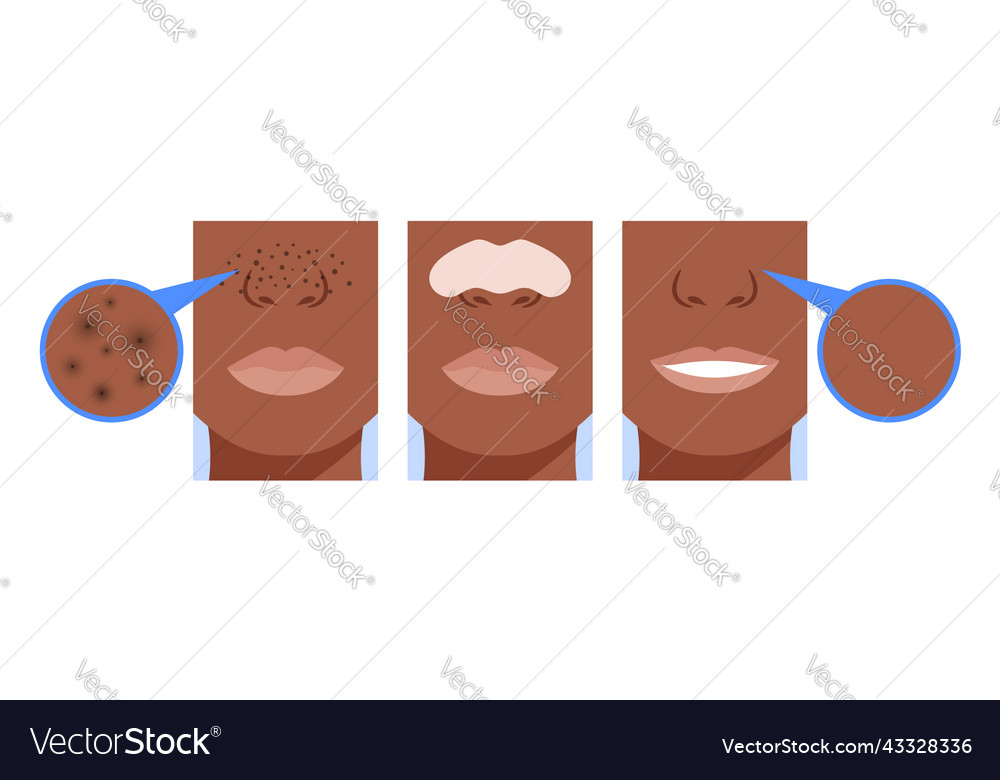 Blackheads before and after nose strips Royalty Free Vector