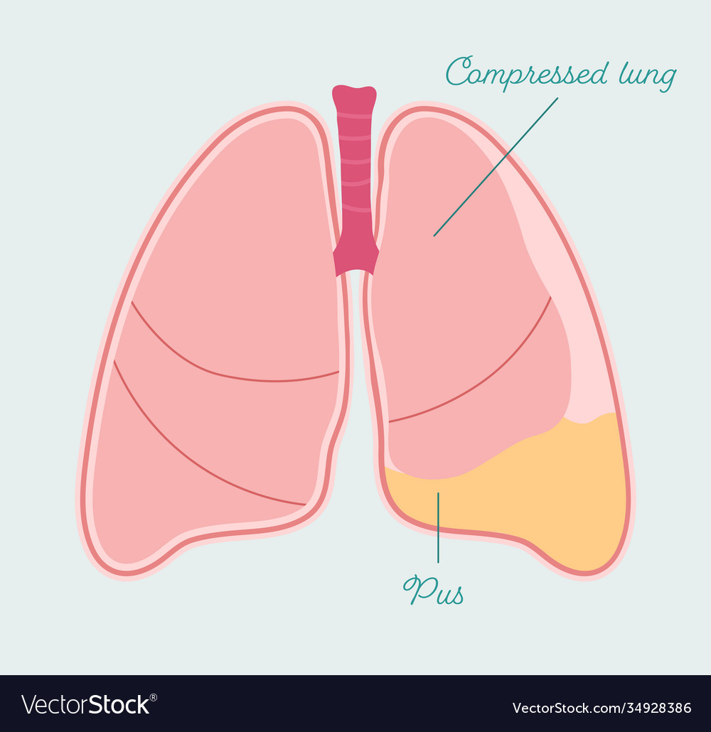 Pyothorax in human lung pleural empyema Royalty Free Vector