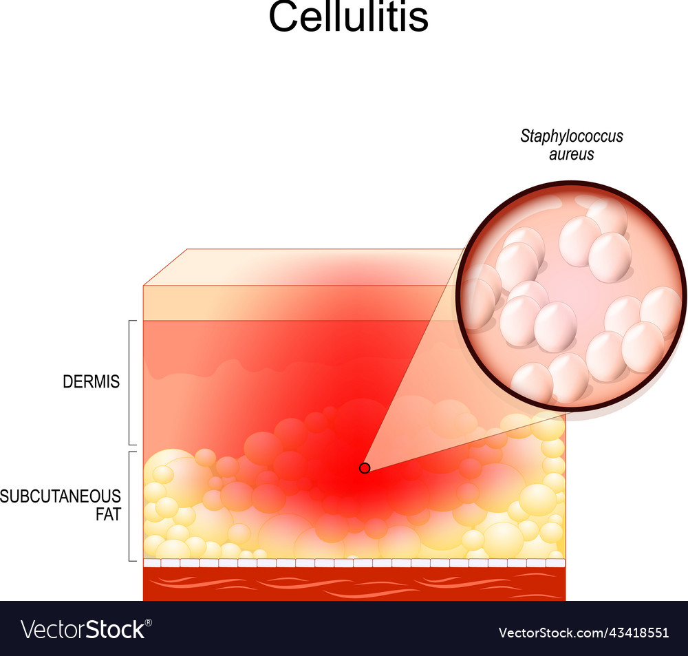 Cellulitis layers of the human skin close-up