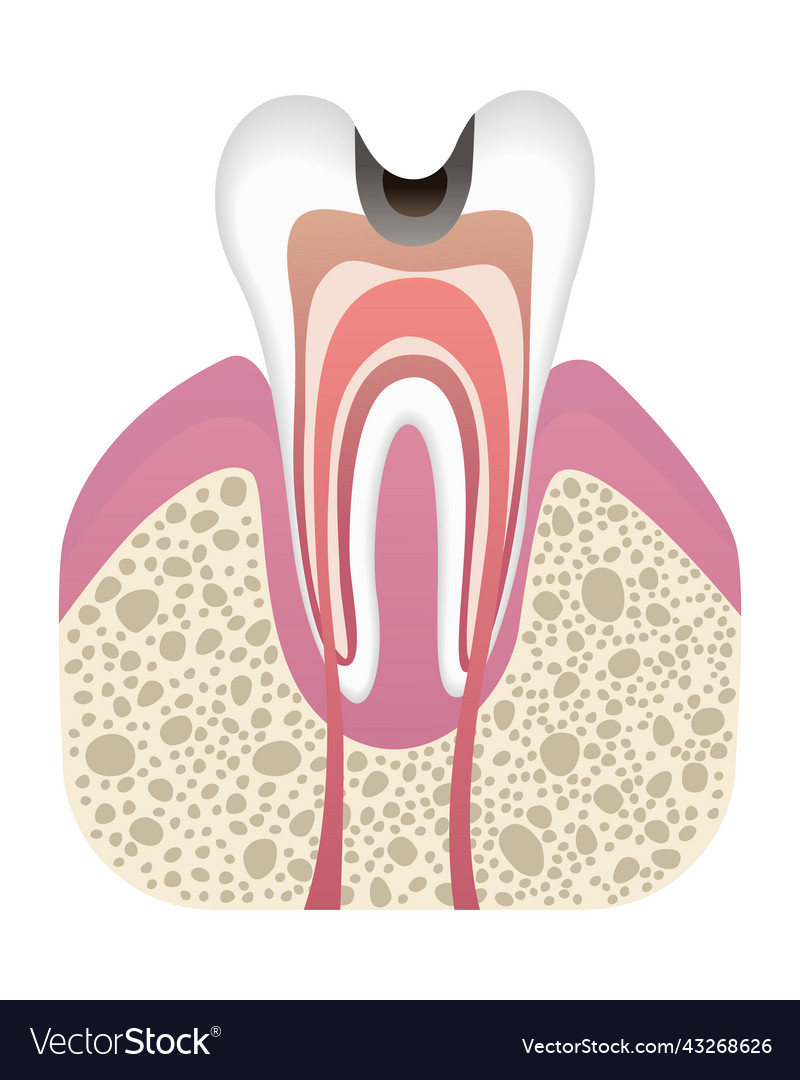 Stage of caries development tooth structure vector image Stage of caries development tooth structure