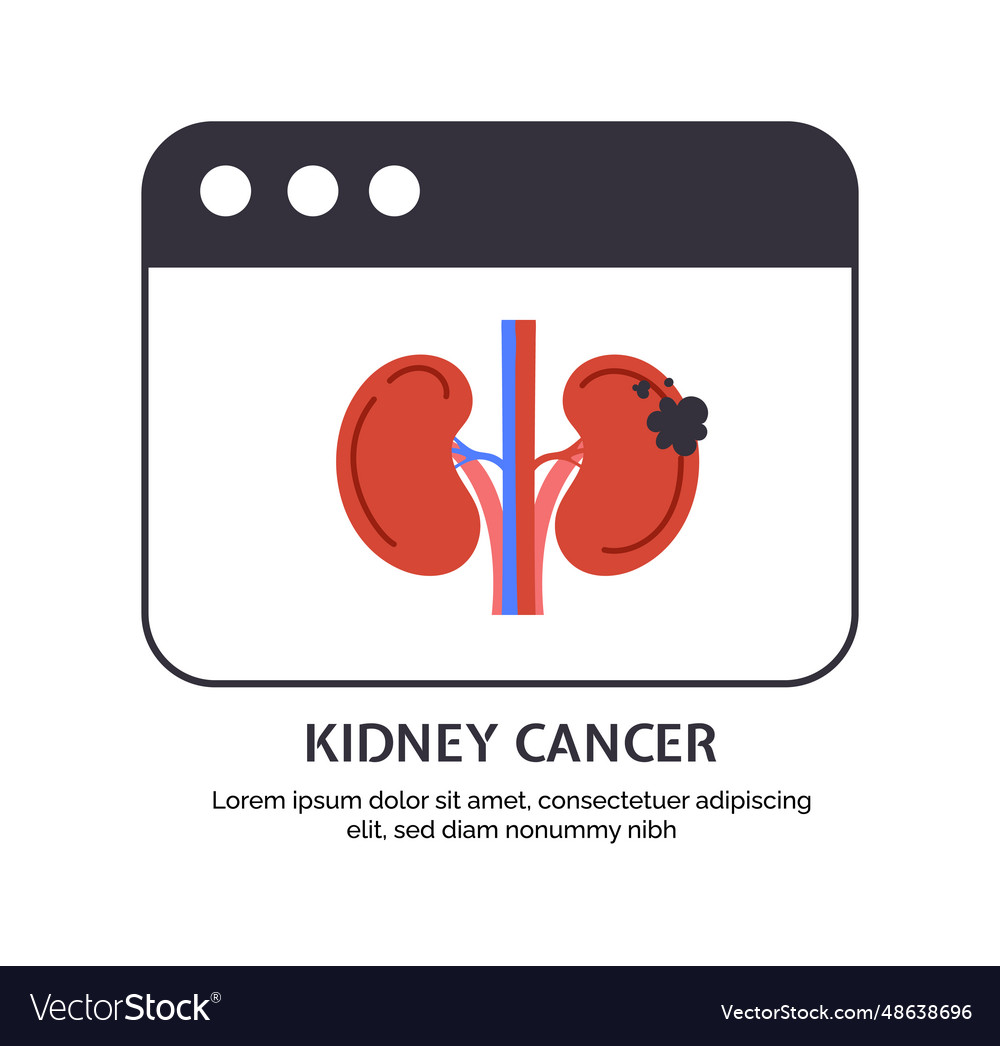 type-of-cancer-kidney-concept-royalty-free-vector-image