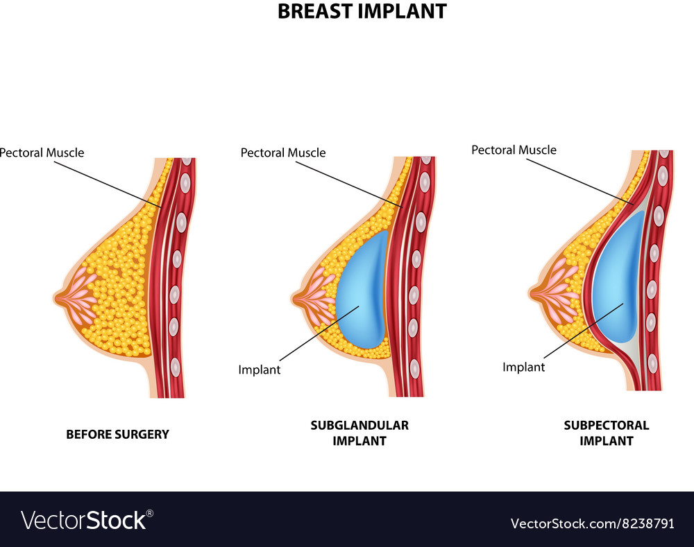 Cartoon of Plastic surgery of breast implant Vector Image