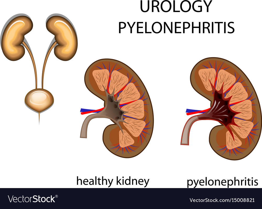 Urology kidney pyelonephritis