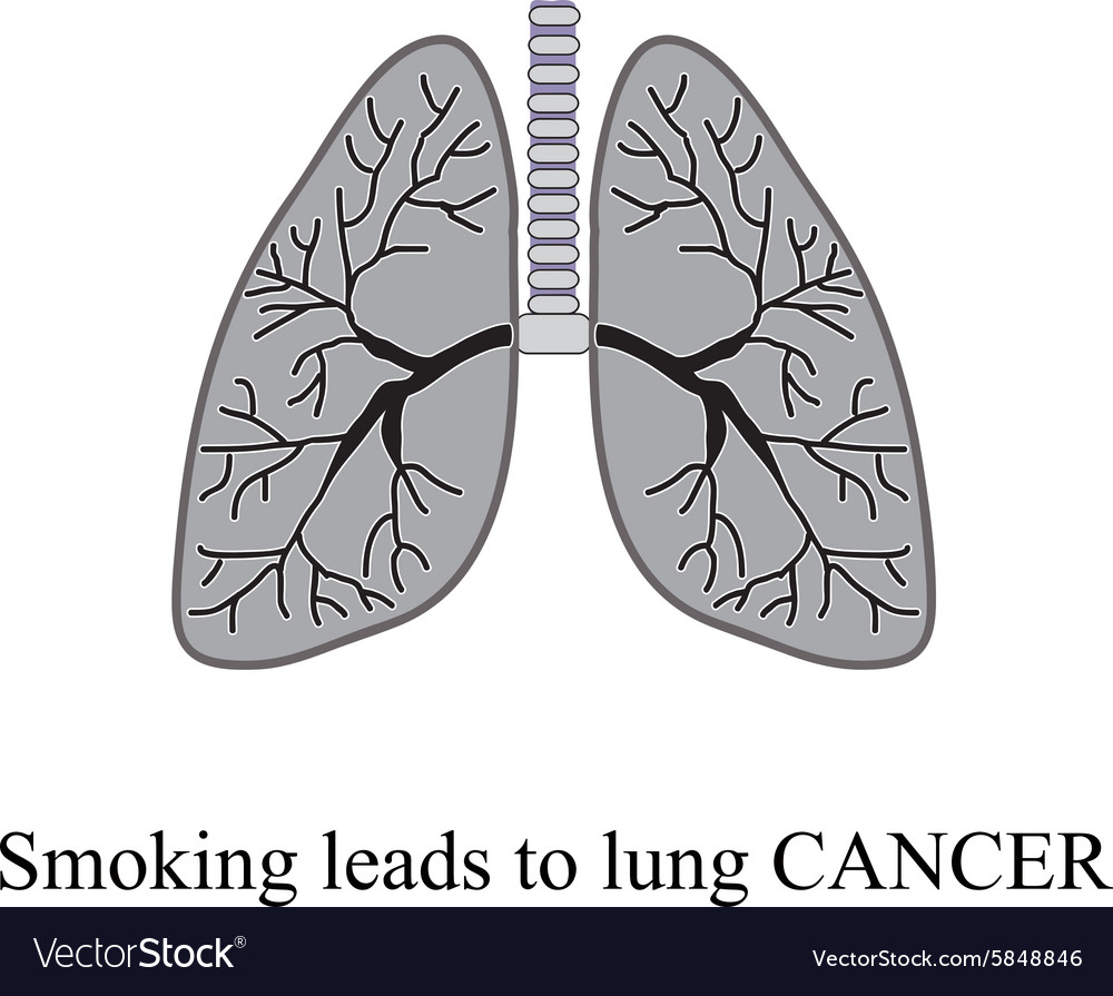 Smoking leads to lung cancer