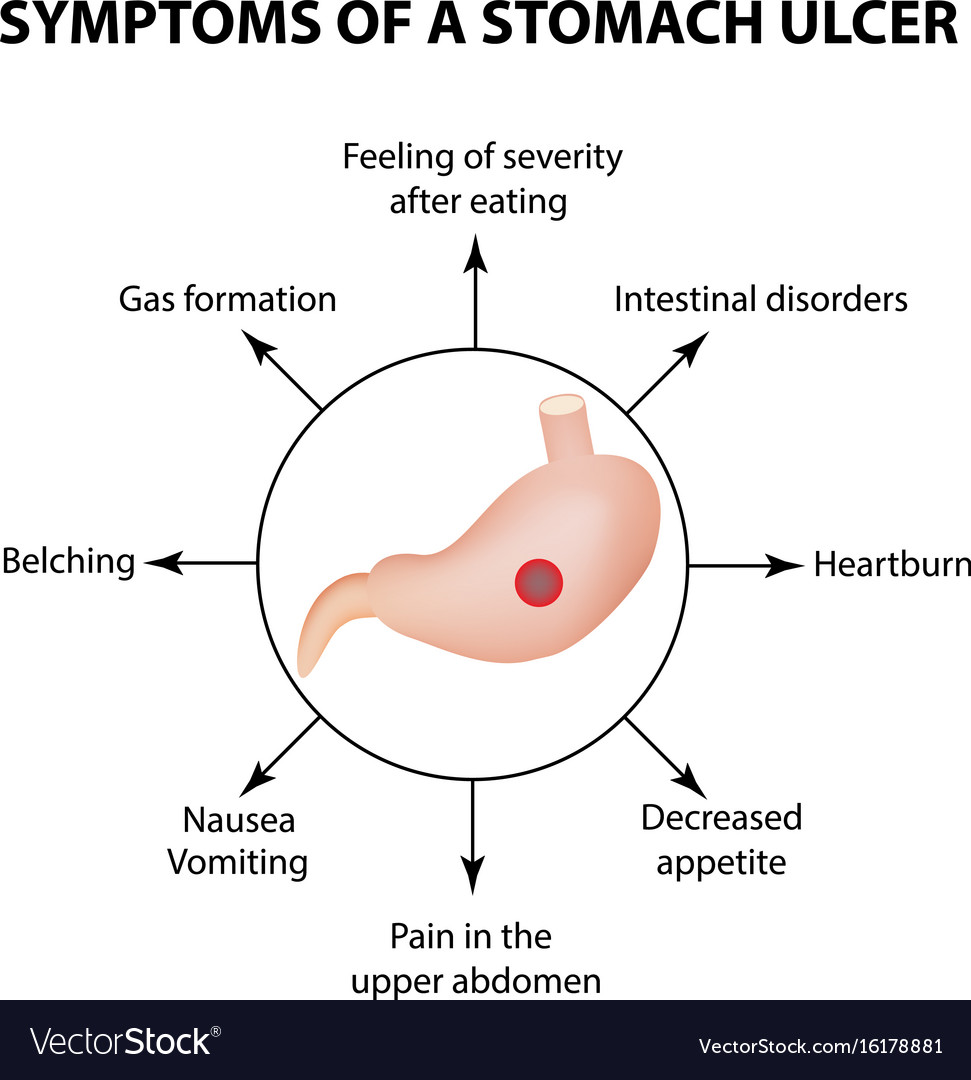 Symptoms a stomach ulcer infographics Royalty Free Vector