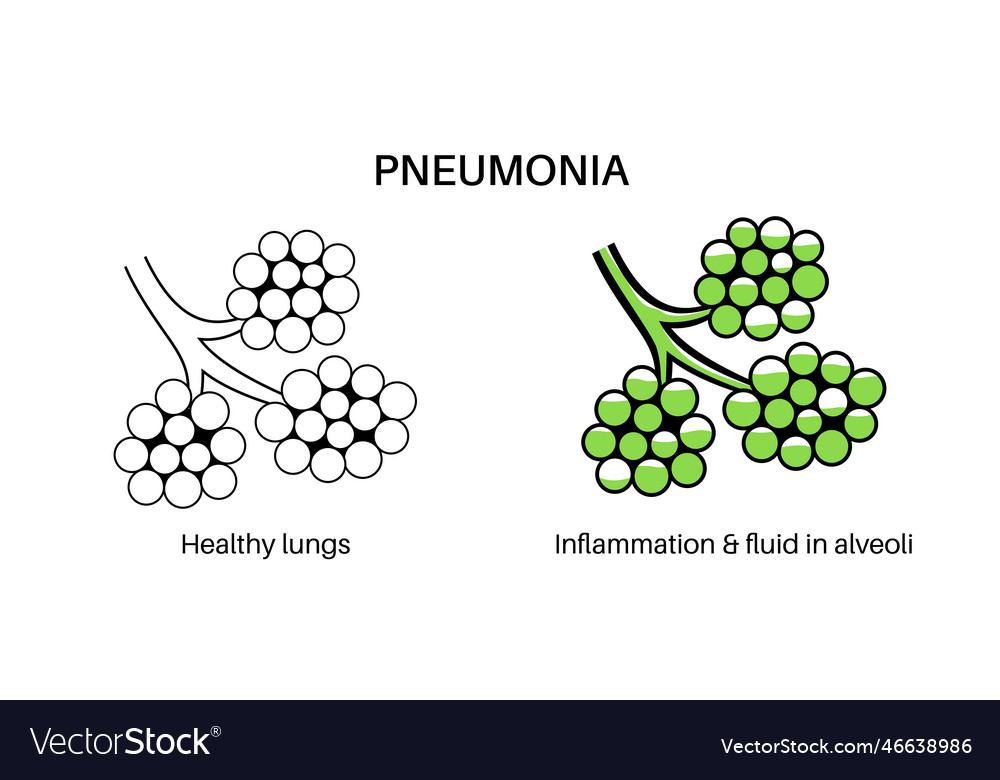 Pneumonia infection poster Royalty Free Vector Image