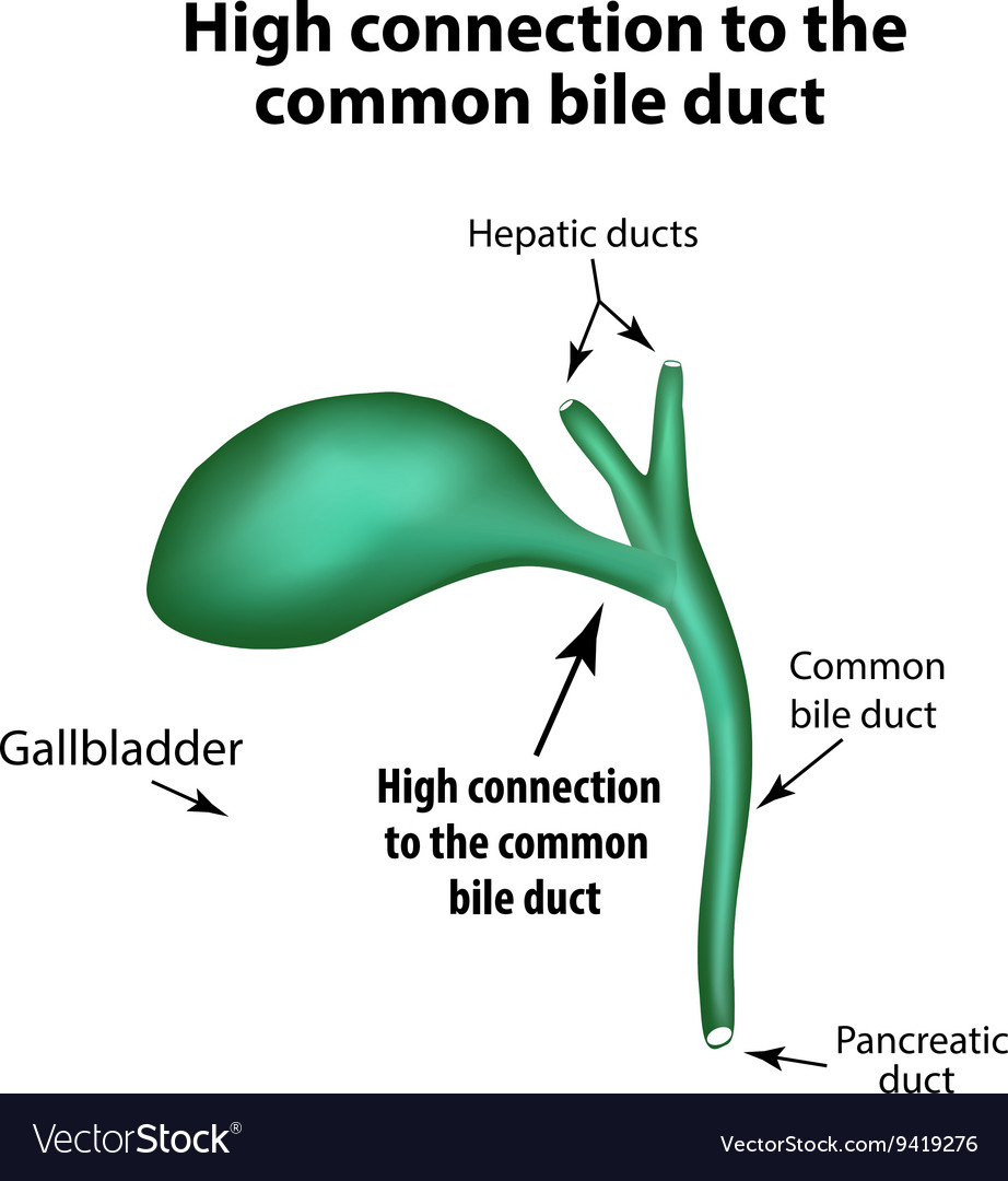 High connection to common bile duct pathology Vector Image