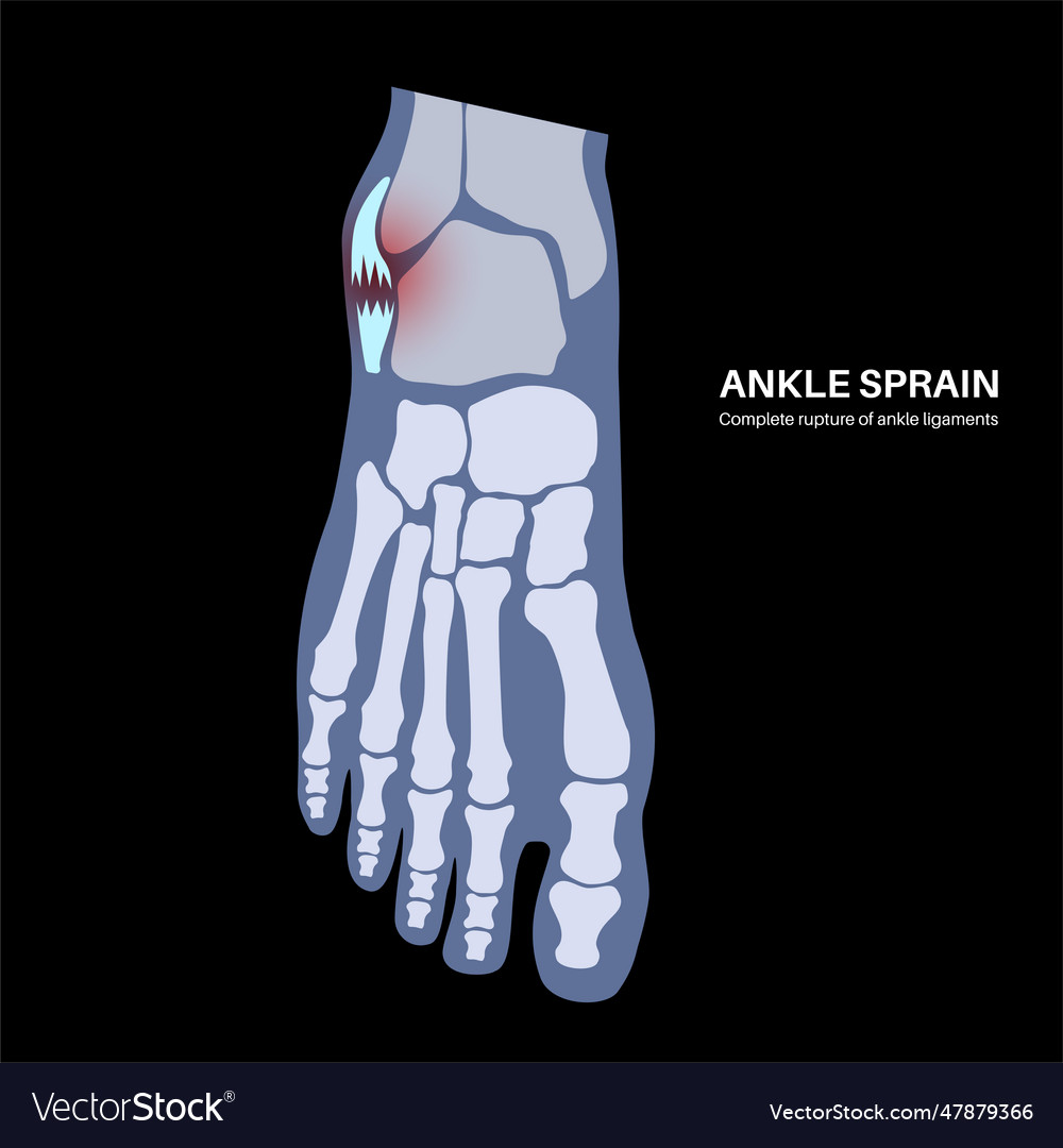 Sprained ankle injury Royalty Free Vector Image