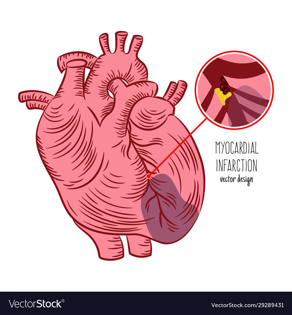 Myocardial Infarction Scheme Heart Attack Medicine Myocardial Infarction Scheme Heart Attack Medicine