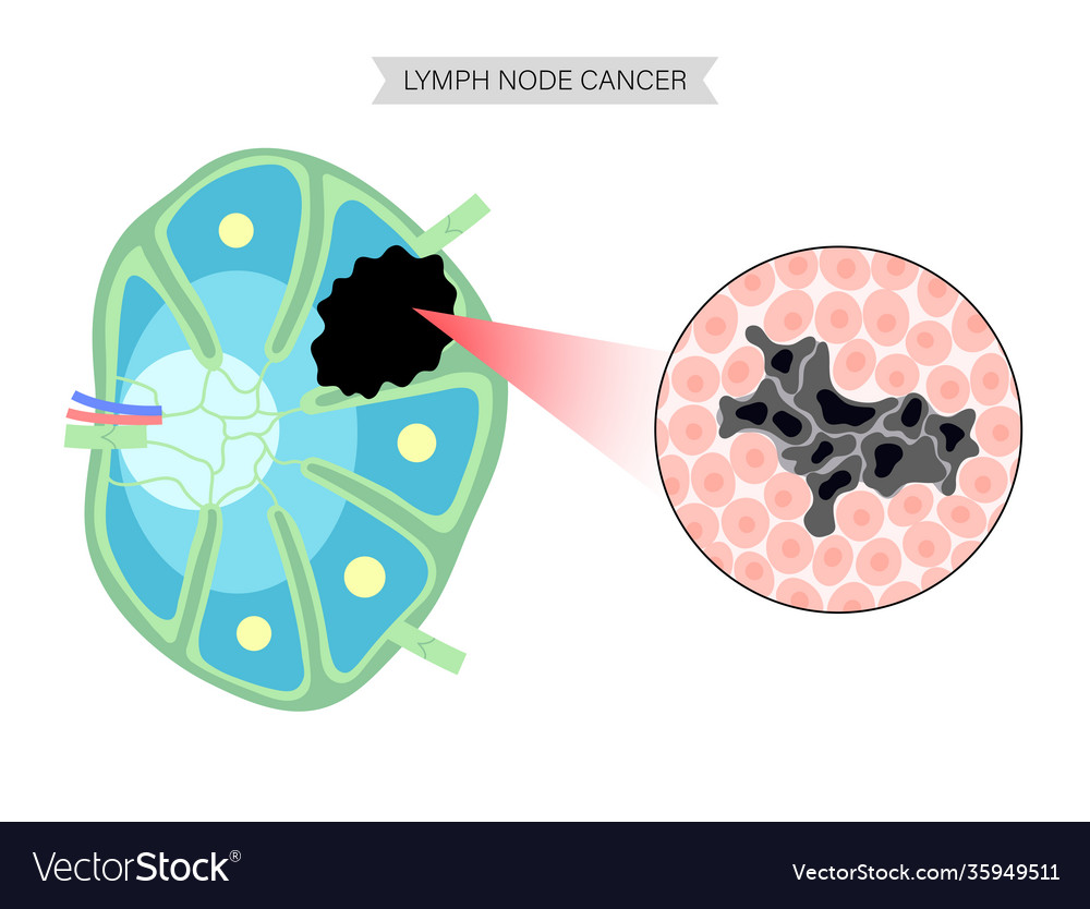 Lymphom Krebs Konzept