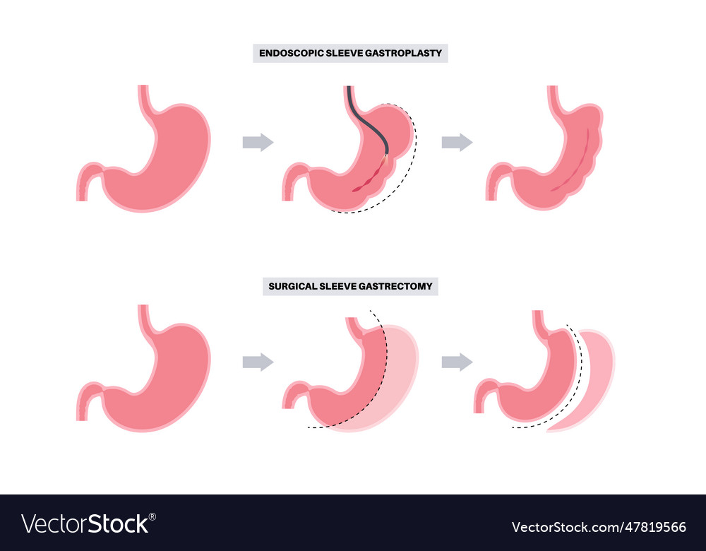 Gastrectomy and gastroplasty Royalty Free Vector Image