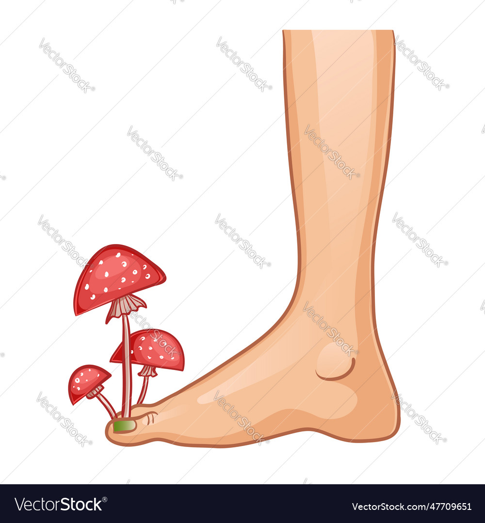 Foot With Fungal Infection Royalty Free Vector Image