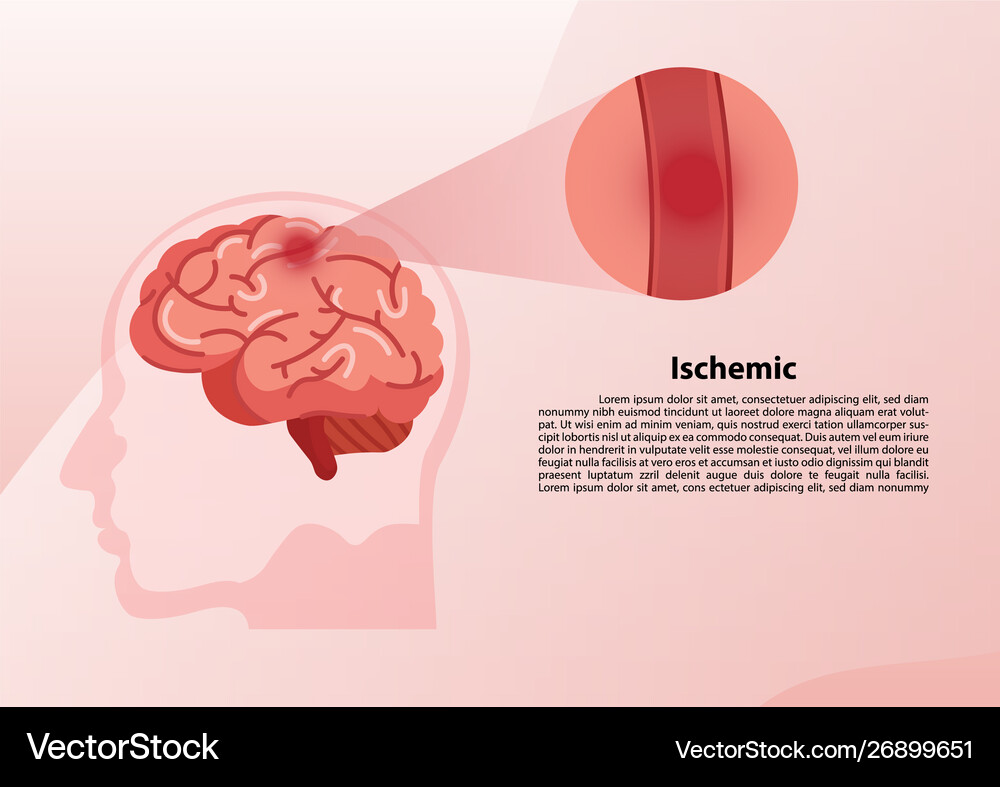 Human brain stroke Royalty Free Vector Image - VectorStock