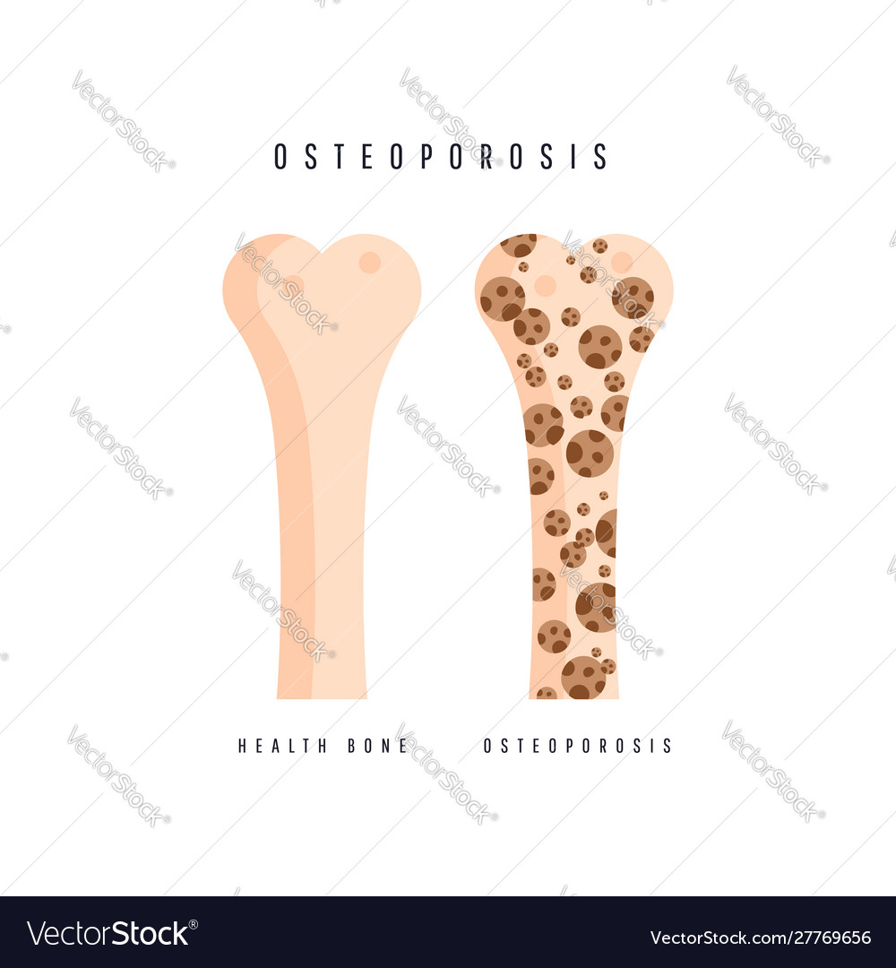 Osteoporosis bone and healthy bone Royalty Free Vector Image