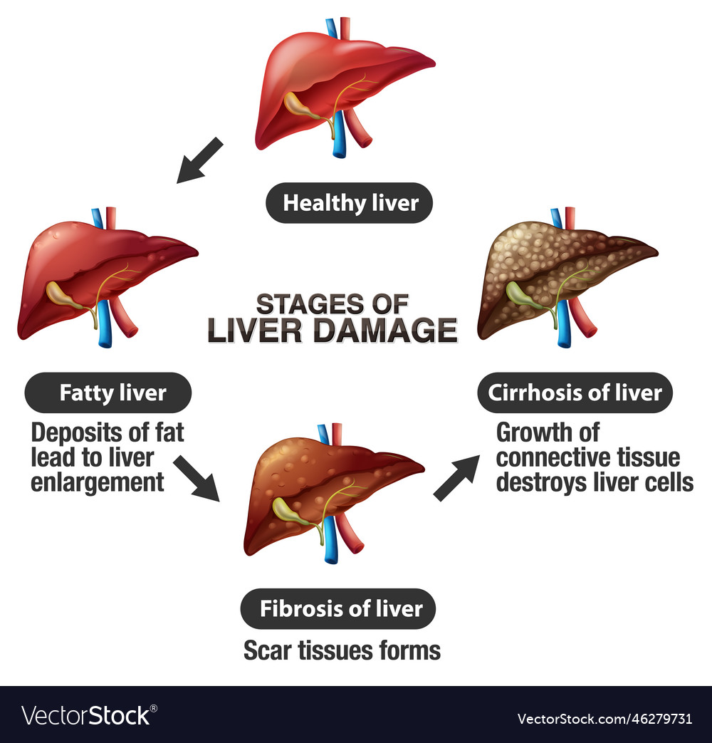 Stages Of Liver Damage Infographic Royalty Free Vector Image