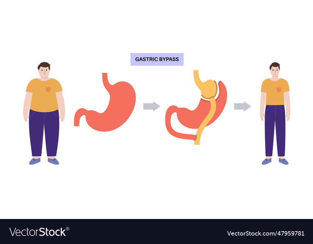 Gastric Bypass Surgery Royalty Free Vector Image