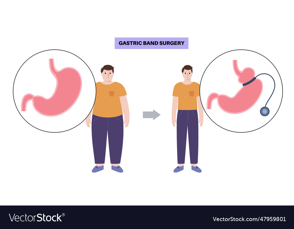 Gastric band poster Royalty Free Vector Image - VectorStock