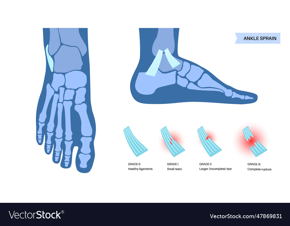 Sprained ankle injury Royalty Free Vector Image