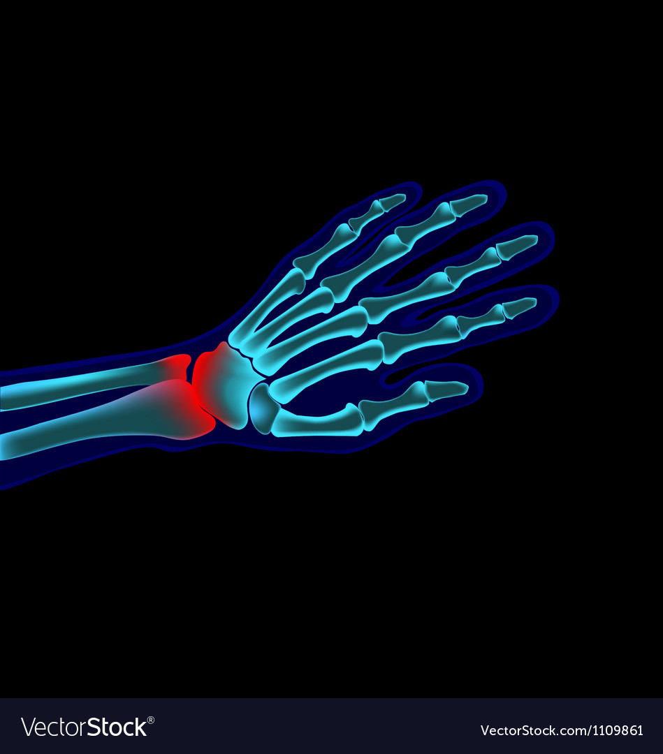Hand X-Ray - Pain and Injury