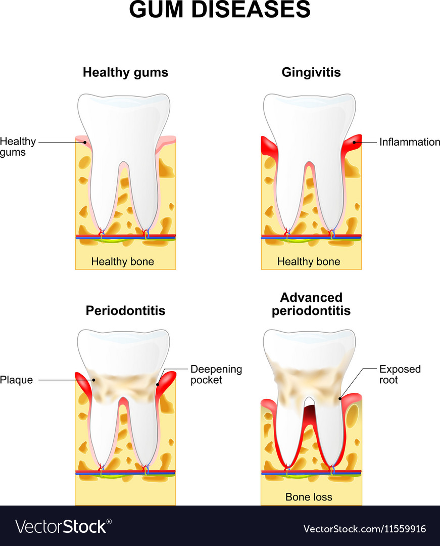 Gingivitis And Periodontitis Royalty Free Vector Image