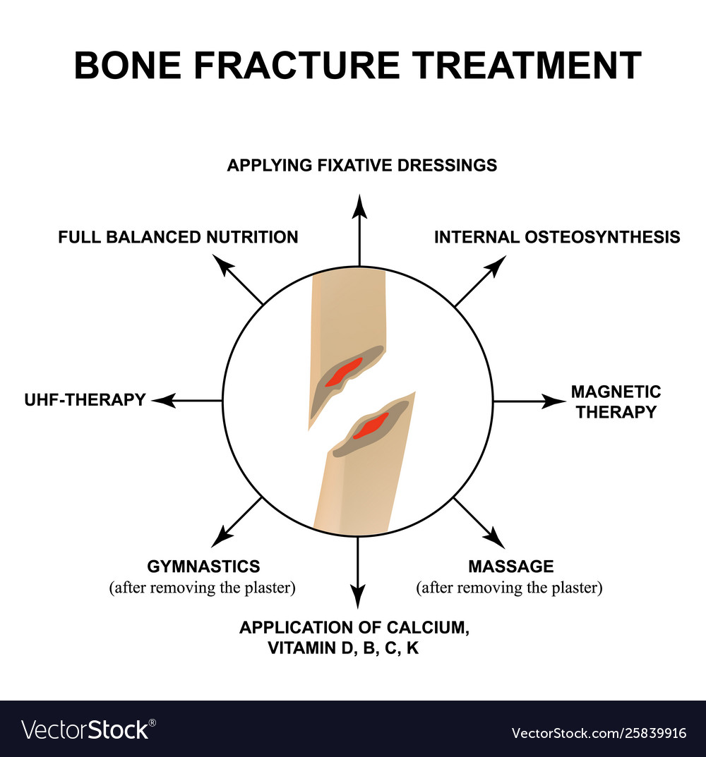 Treatment Bone Fractures Fracture Royalty Free Vector Image