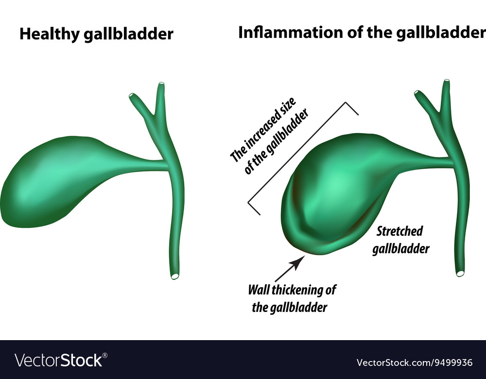 Как быстро снять воспаление желчного Symptoms of gallbladder inflammation Royalty Free Vector