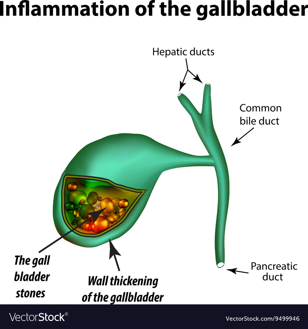 Gallstones Cholelithiasis Cholecystitis Royalty Free Vector