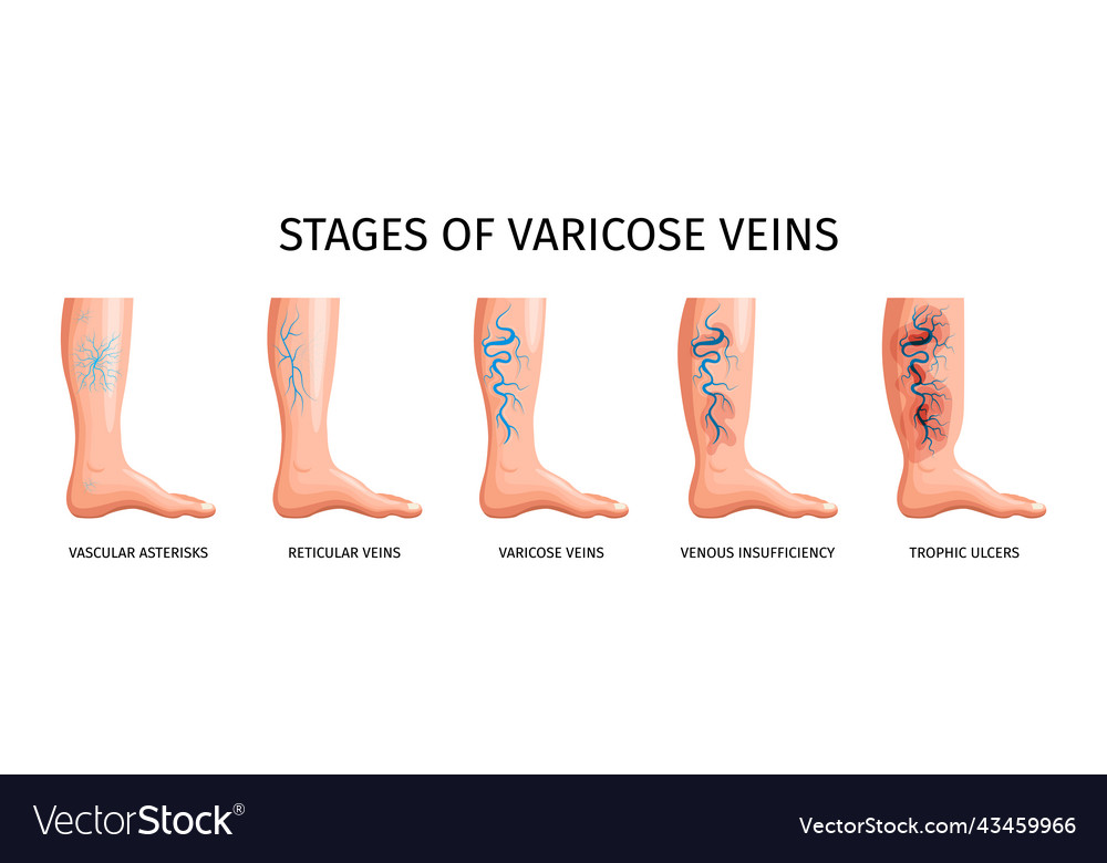 Stages of varicose veins Royalty Free Vector Image