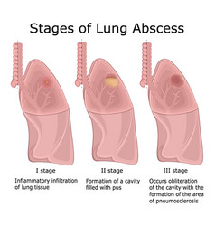 Lung abscess Royalty Free Vector Image - VectorStock