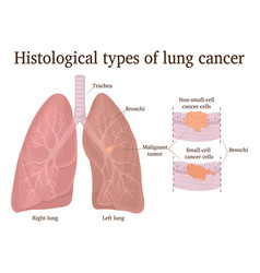 Lung abscess Royalty Free Vector Image - VectorStock