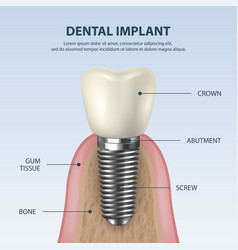 3d realistic render white tooth implant Royalty Free Vector