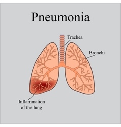 Pneumonia The anatomical structure of the human Vector Image