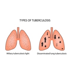 Types tuberculosis military and disseminated Vector Image