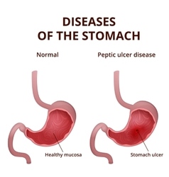 Anatomy of the human healthy and unhealthy stomach